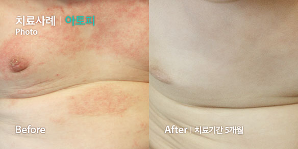 치료사례-아토피
