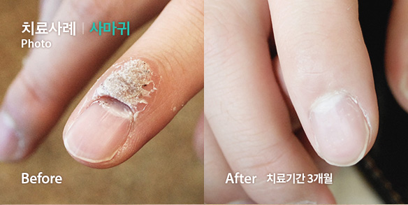 치료사례-사마귀