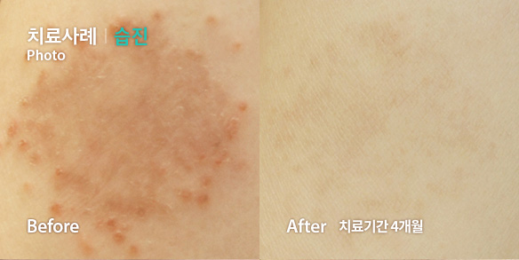 치료사례-습진