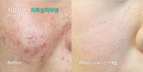 치료사례-지루성피부염