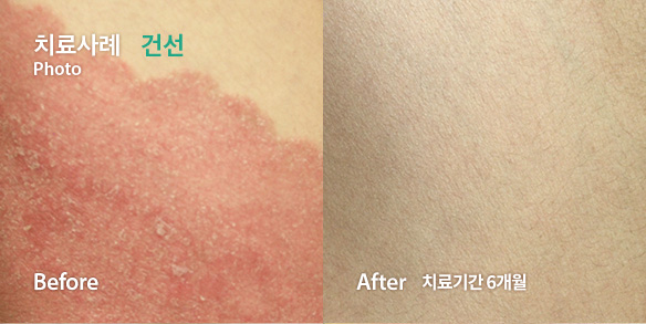 치료사례-건선