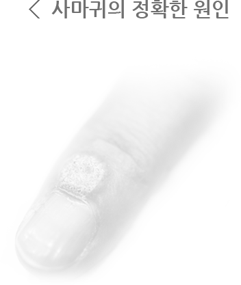 사마귀의 정확한 원인