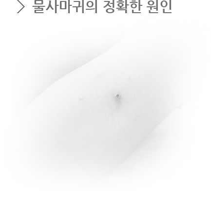 물사마귀의 정확한 원인