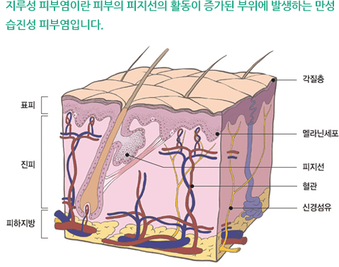 지루성 피부염이란 피부의 피지선의 활동이 증가된 부위에 발생하는 만성 습진성 피부염입니다. 