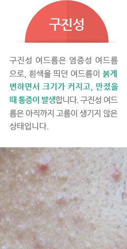 구진성 - 구진성 여드름은 염증성 여드름 으로, 흰색을 띄던 여드름이 붉게 변하면서 크기가 커지고, 만졌을 때 통증이 발생합니다. 구진성 여드 름은 아직까지 고름이 생기지 않은 상태입니다.