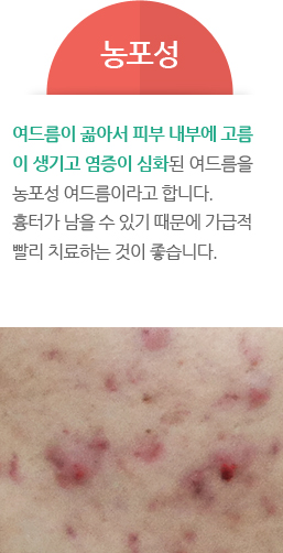농포성- 여드름이 곪아서 피부 내부에 고름 이 생기고 염증이 심화된 여드름을 농포성 여드름이라고 합니다. 흉터가 남을 수 있기 때문에 가급적 빨리 치료하는 것이 좋습니다.