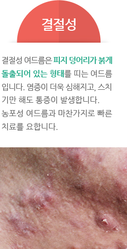 결절성 - 결절성 여드름은 피지 덩어리가 붉게 돌출되어 있는 형태를 띠는 여드름 입니다. 염증이 더욱 심해지고, 스치 기만 해도 통증이 발생합니다. 농포성 여드름과 마찬가지로 빠른 치료를 요합니다.